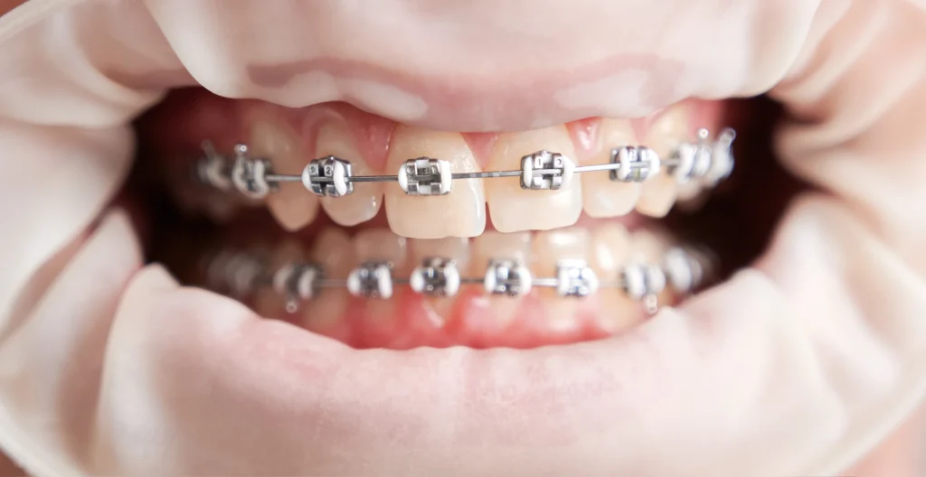 BRACES