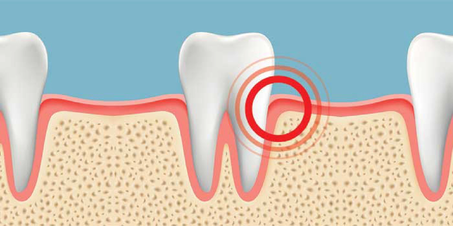 gums2