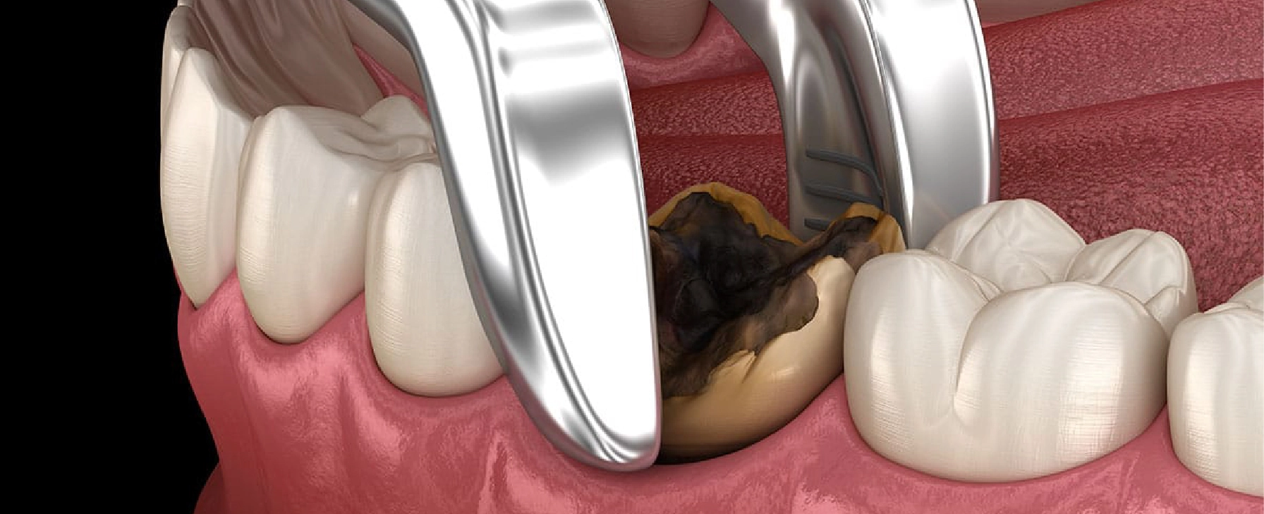 tooth-extraction-1